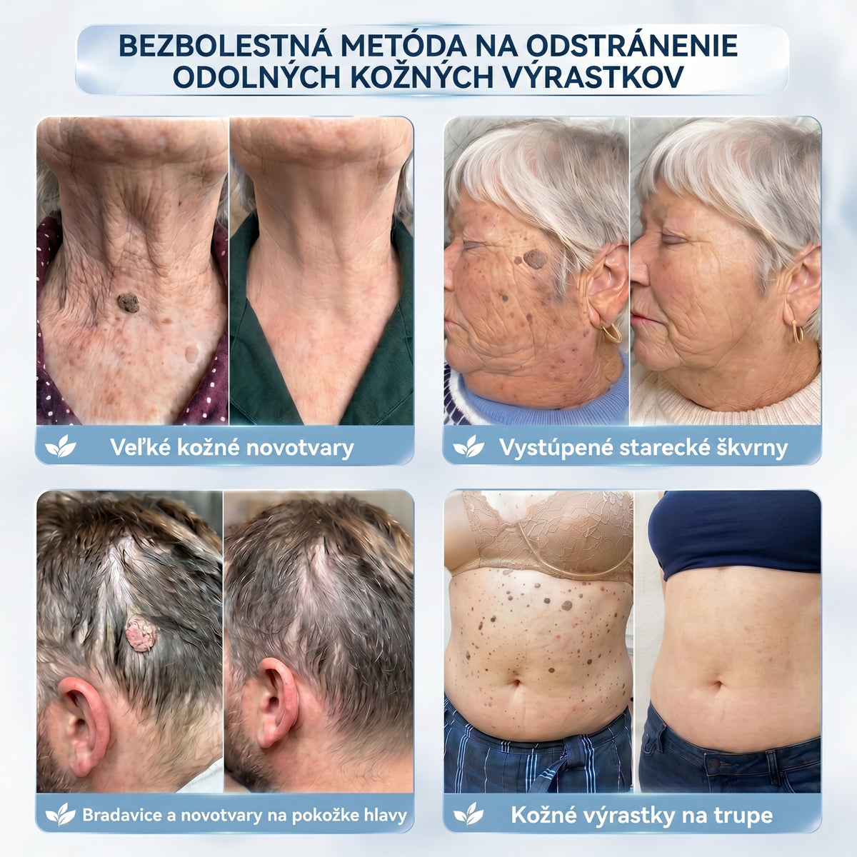 𝐇𝐢𝐬𝐤𝐢𝐧® 2-v-1 pokročilý bezbolestný krém na obnovu pokožky bez viditeľných jaziev – proti kožným výrastkom, bradaviciam a viditeľným nedokonalostiam pokožky