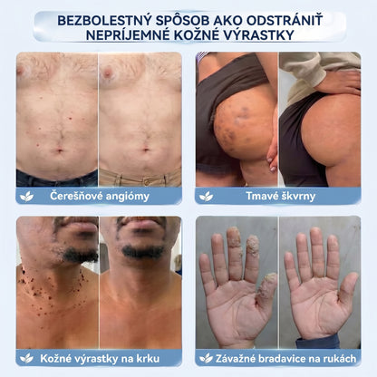 𝐇𝐢𝐬𝐤𝐢𝐧® 2-v-1 pokročilý bezbolestný krém na obnovu pokožky bez viditeľných jaziev – proti kožným výrastkom, bradaviciam a viditeľným nedokonalostiam pokožky